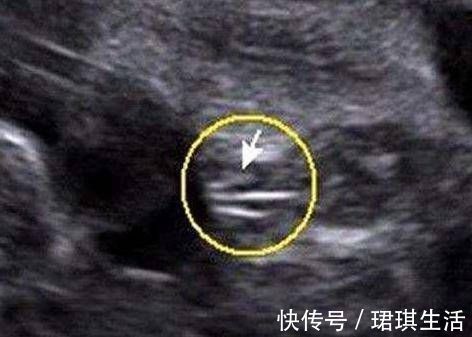 B超|原来男宝宝的B超是这样的,四维彩超单上的暗示,准妈妈你知道吗