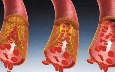 粘稠|身体出现这些症状, 你的血液已很粘稠了, 现在发现还不晚!