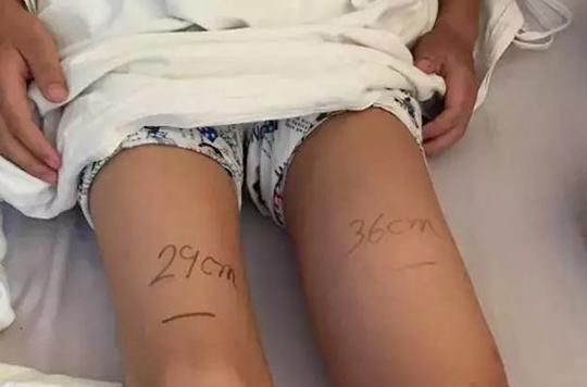 生理性|8岁孩子喊“腿痛”,家人误以为是生长痛,殊不知得了“骨肉瘤”