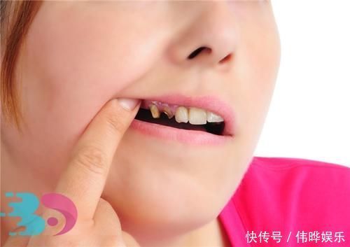 上火牙龈肿痛小妙招