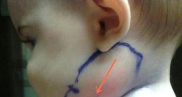 医生|宝宝脖子突然长羽毛,家人认为是天使,医生怒斥怎么当妈的!