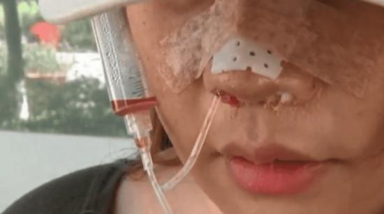 假体 女生花6万整容,手术失败脸上要挂着注射器,医院:赔给你一万三