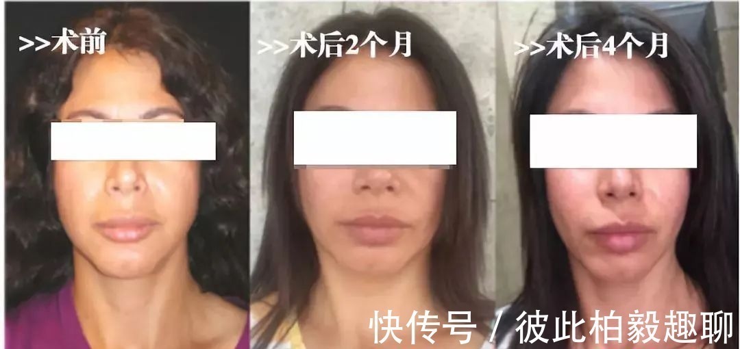 整形 这5个医美项目虽然很火,但很多医生不建议做!丨科普篇