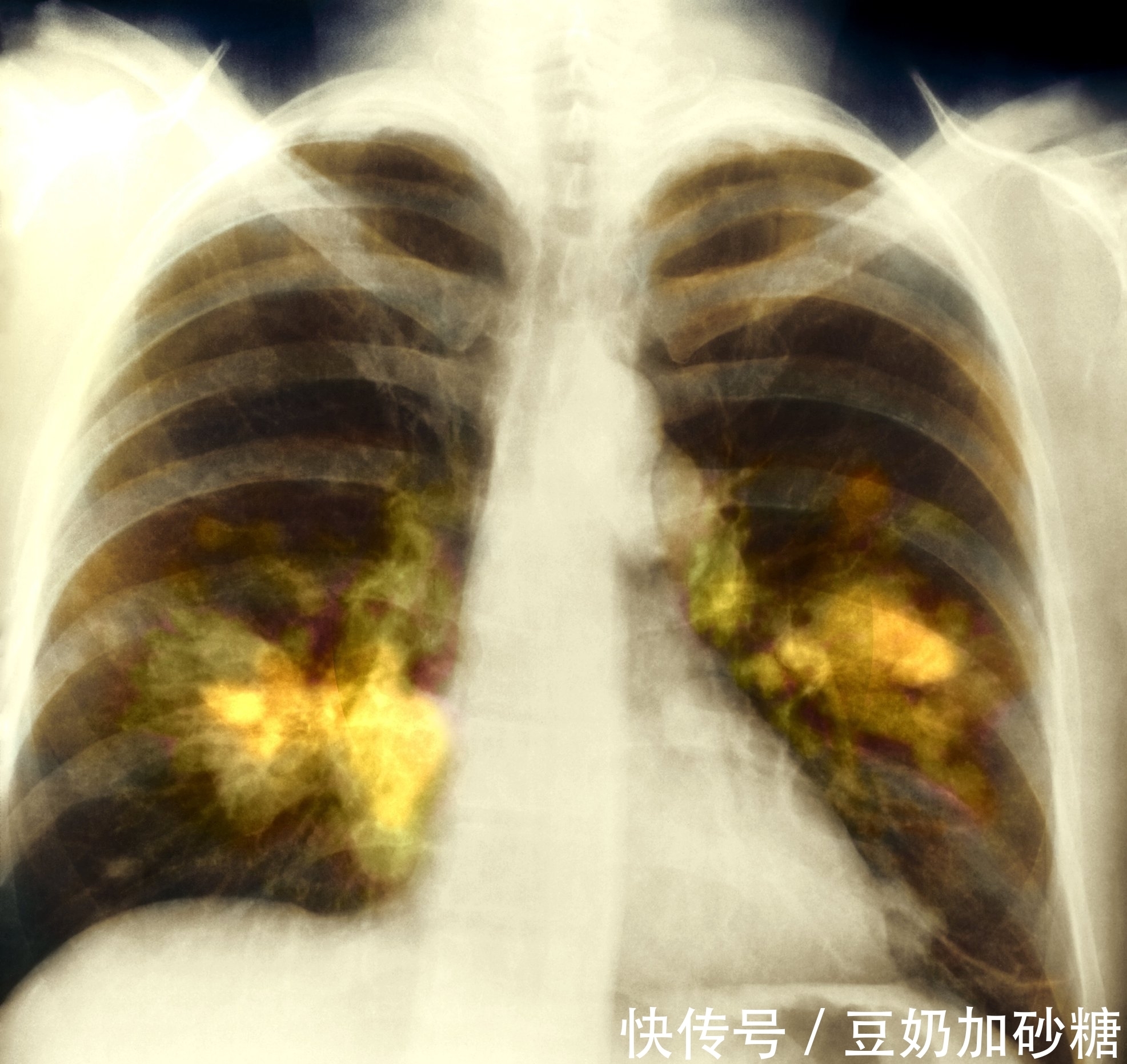 x光片|肺肿块或结节,一定是肺癌吗?