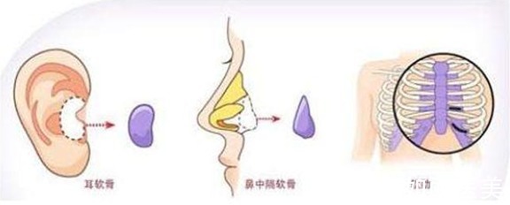 注射隆鼻 隆鼻手术一般多少钱?隆鼻能保持多久?