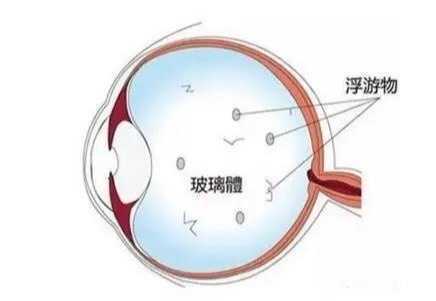 近视引起的这4大并发症,竟然还有这样的危害!