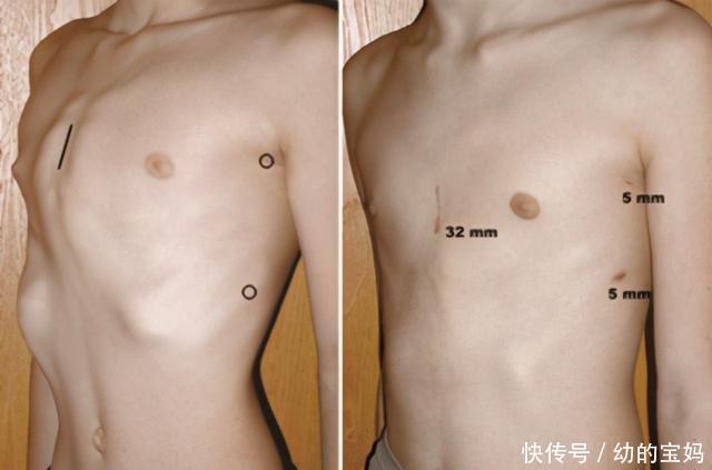 村里的孩子诊断为鸡胸,是缺钙引起的吗?如何预防孩子鸡胸?