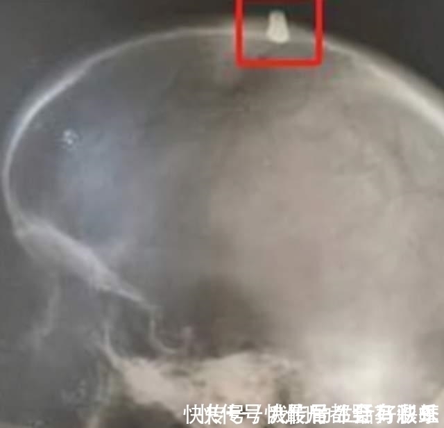 运动服|男子被子弹击中头部奇迹幸存,子弹卡在头骨上,却有了意外收获