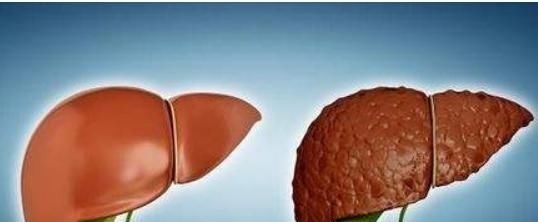 长期|肝硬化才不会“悄无声息”,早期信号一定别忽视,还好早知道