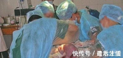 陈女士|女子肚大如球以为是怀了2个,剖宫产原来一个是惊一个是喜!