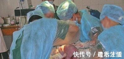 陈女士|女子肚大如球以为是怀了2个，剖宫产原来一个是惊一个是喜！