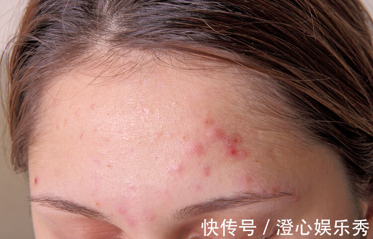 牙痛|“有病没病,防风通圣”:除了止痒外,防风通圣丸还有6种妙用