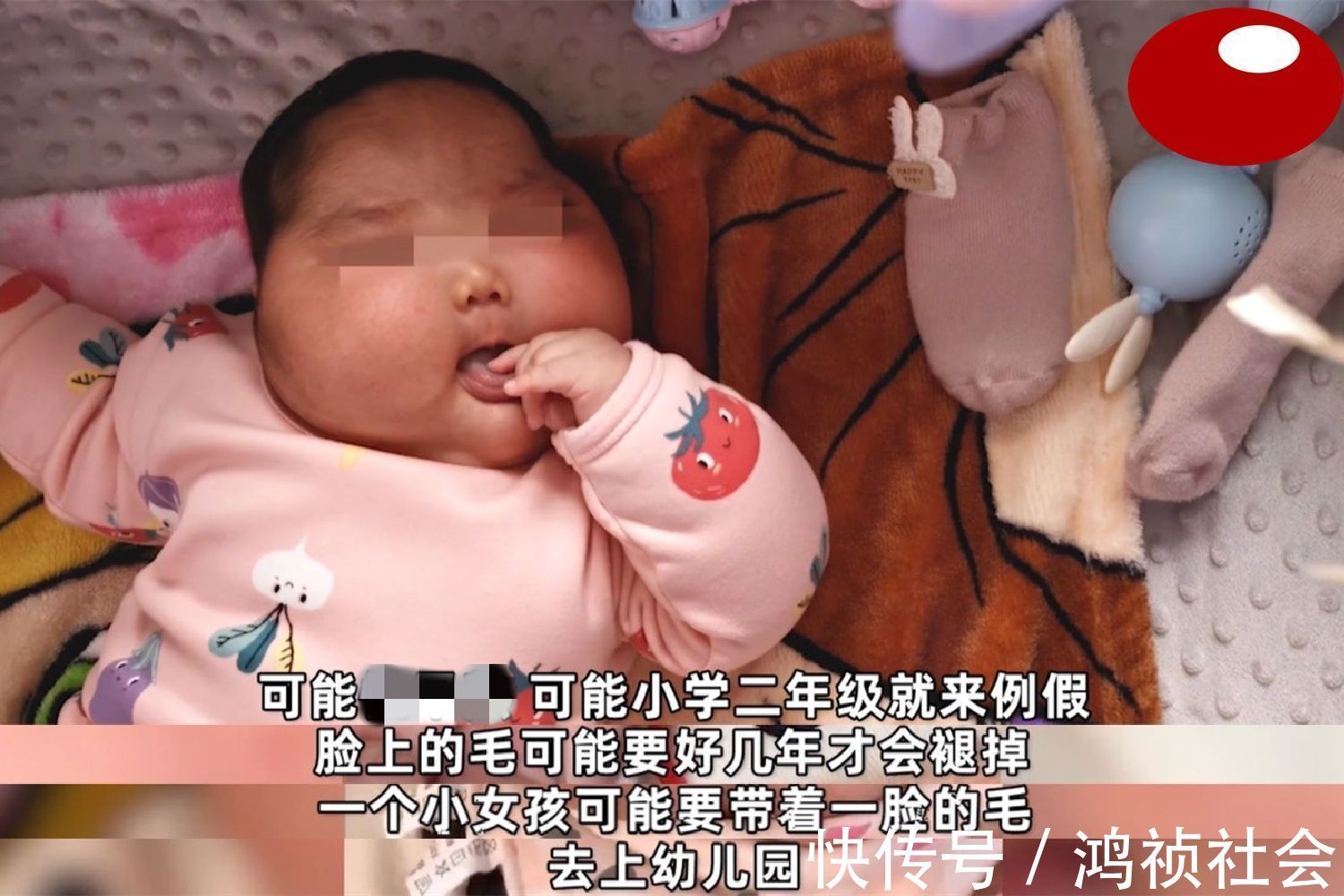 氯倍他索丙酸酯|“大头娃娃”再现,抑菌霜激素超标,致5个月女婴疯狂长胖长毛