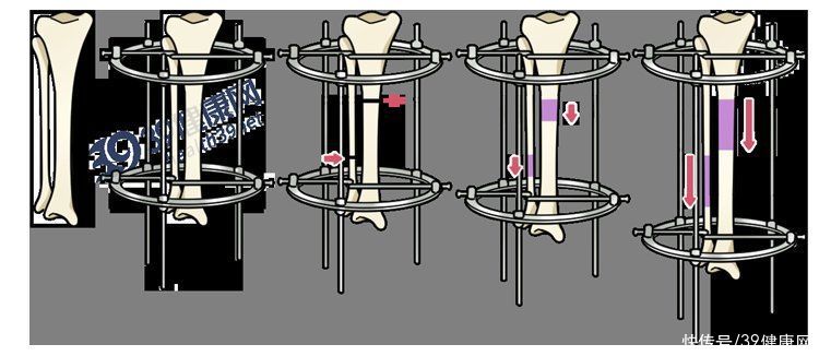 髓内针|做了断骨增高术的人，最后都怎样了？一旦失败，这3个后果在等着