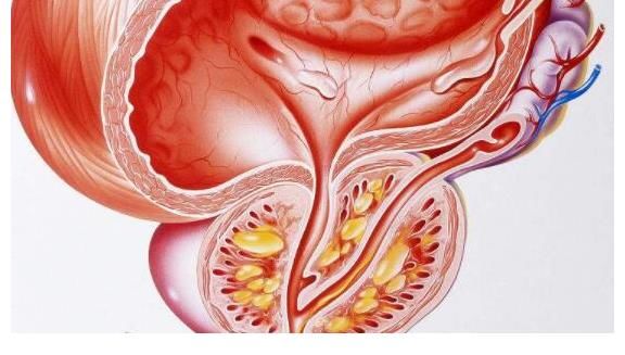 前列腺病变|一个月“排精”10次可缓解前列腺炎？医生解答：多吃1物，炎症慢慢消除