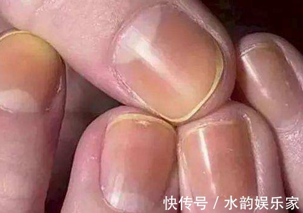 病变|肝脏没有痛觉，发现就是晚期！手上出现3种信号，提示你病变了