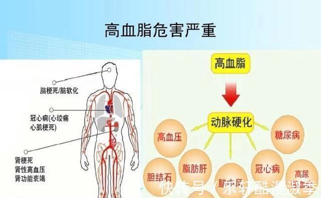 血脂|如何快速降低血脂