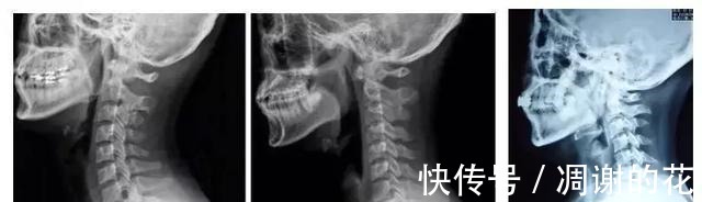 腰椎|矿泉水瓶对颈椎病竟有妙用原理在哪!