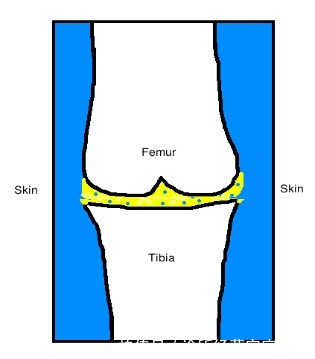 骨性关节炎|一个伤膝盖的动作,你可能每天都在做