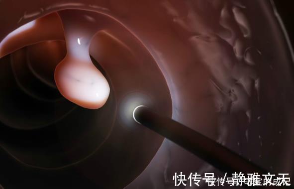 恶性|四部分的息肉，最好及时切除，癌症可能会出现很长一段时间！