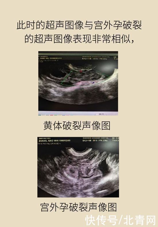 腹痛|这种腹痛常被误认宫外孕，背后诱因要牢记