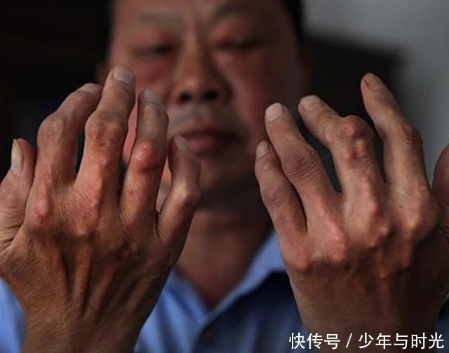 高尿酸患者|尿酸高的人,身体若有这4大“迹象”,可能是肾脏要走下坡路了!