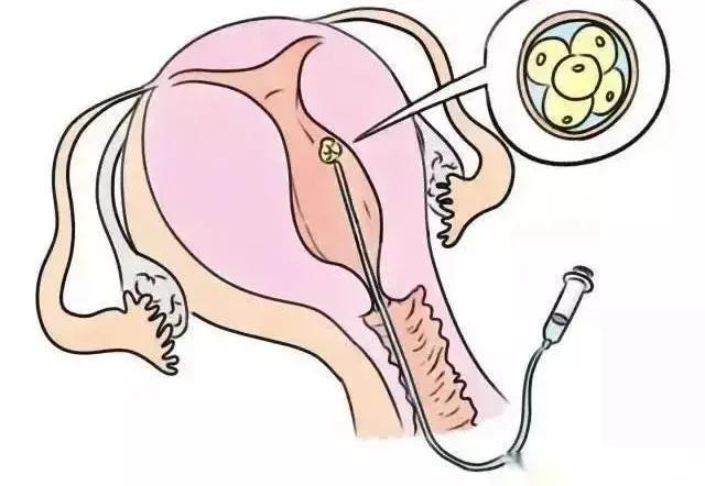 过程|试管流程中,哪个流程是最疼的