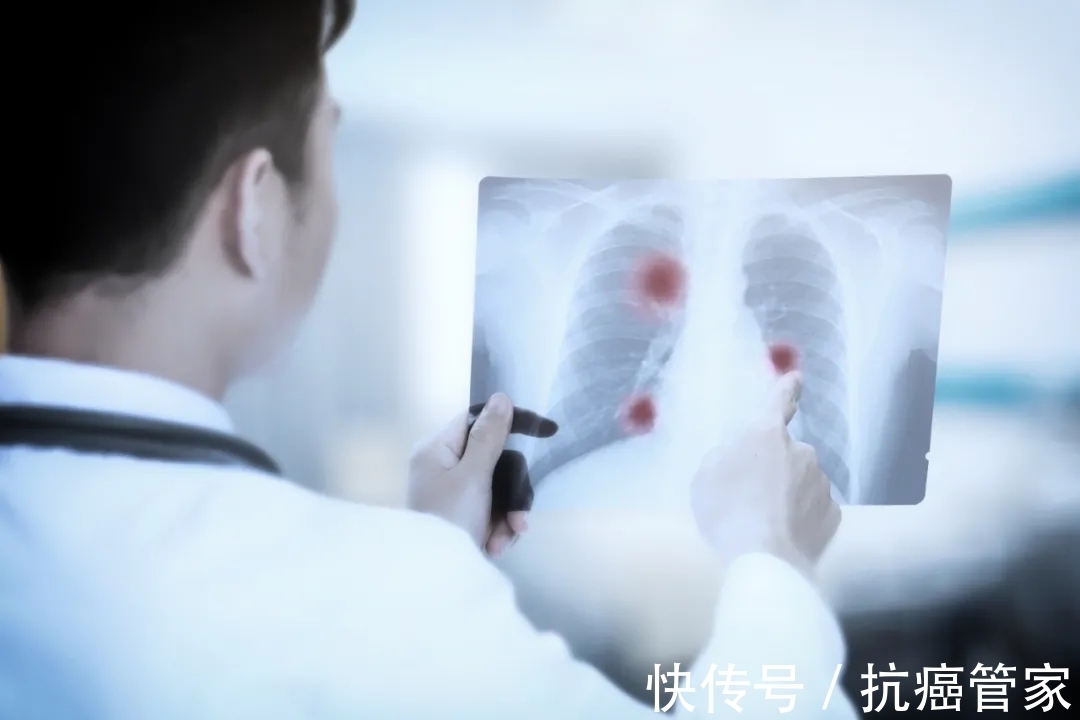 癌细胞|大肿瘤无转移,小肿瘤却大转移?肺癌转移究竟怎么回事?