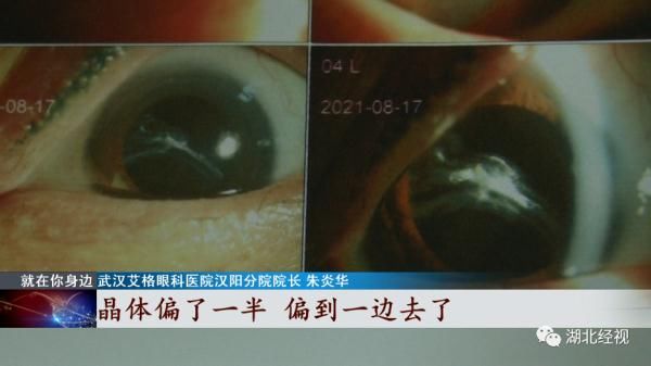 晶体|女子治疗脱发，眼睛晶体竟然脱落！只因这个操作