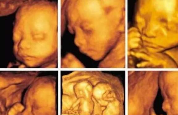 b超|在排畸检查时,为什么胎宝宝要挡住脸?