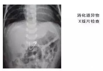 喉咙|小小一枚,孩子喉管被腐蚀!再说一遍,这些东西必须放好了