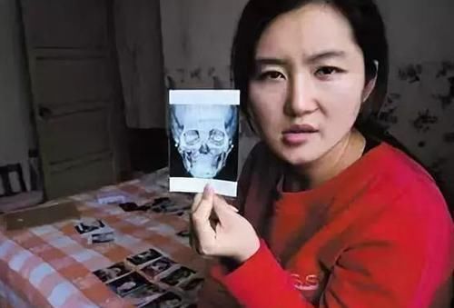 医院|25岁姑娘花3万多整容，却整成了十级伤残？医院：赔你5000元！