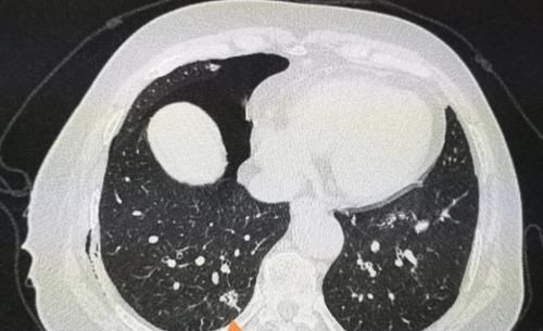 肺结节|癌症病人的幸运指数不一样，这位老太太想感谢一个吹破的肺大泡