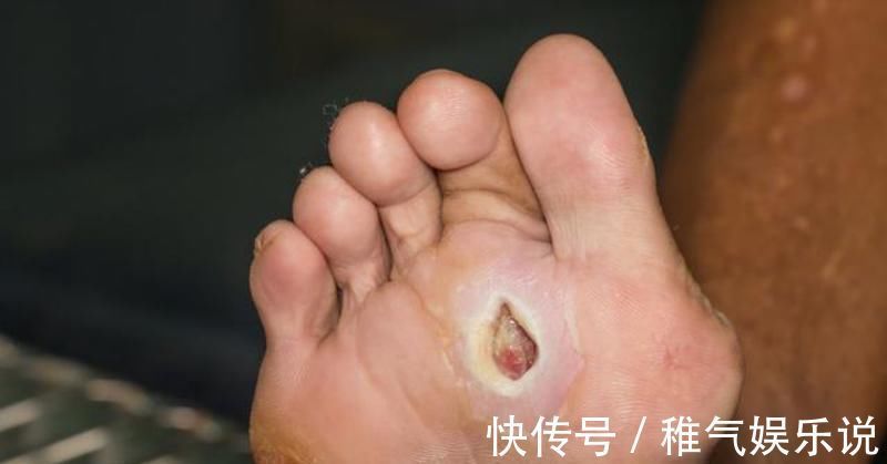 青钱柳|脚部出现3症状,代表糖尿病足来了不想截肢,牢记这3件事