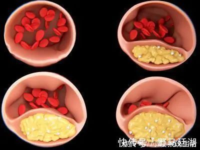 心梗|两味中药煮水喝,活血化瘀通血管,预防心梗、脑梗