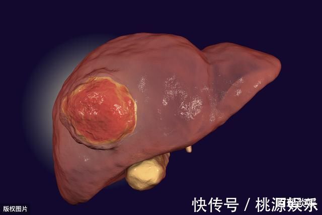部位|肝脏是“哑巴”，身体3个部位持续“发臭”，可能是肝癌前兆