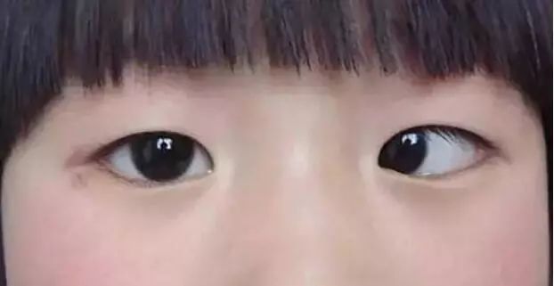 家长|6岁孩子常玩这玩具,导致黑眼珠逐渐消失,家长要当回事