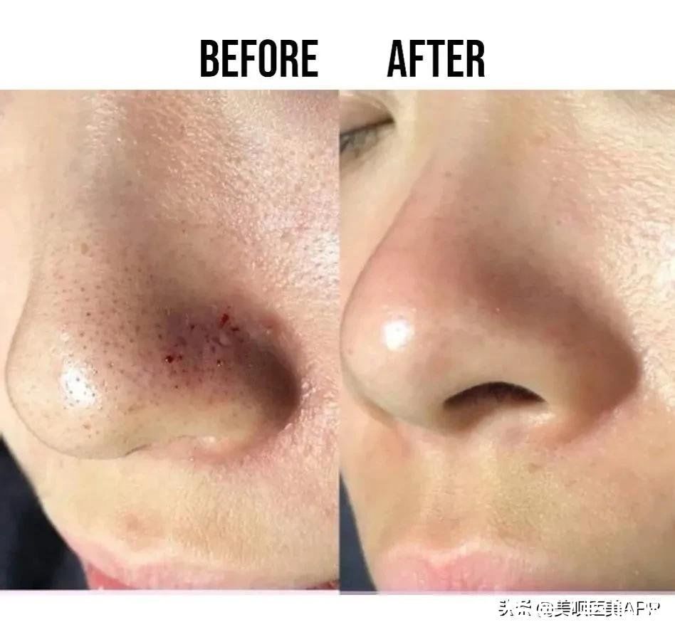 爱豆们竞当医美达人？男性适合的轻医美项目top5合集