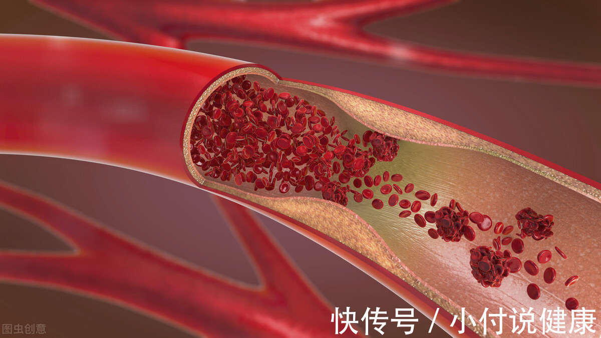 血管|一份高血压患者的饮食指南,请收好