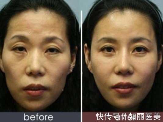 自体脂肪 自体脂肪填充术后能保持多久,会不会很快代谢掉?