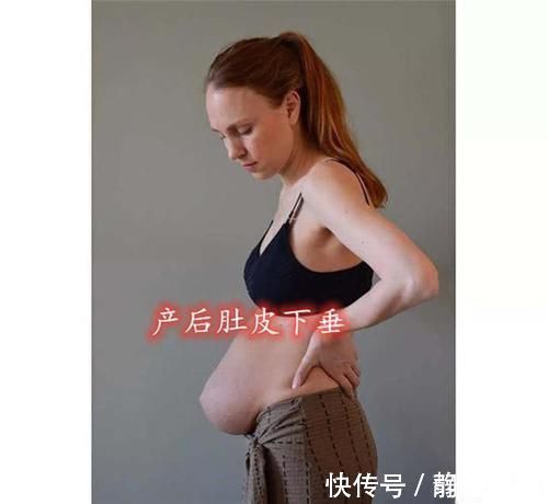 腹直肌|宝妈生完3胞胎后,肚皮严重下坠“收不回来”,网友心疼又害怕