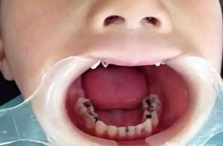 牙齿|让娃满口“小黑牙”的始作俑者并非糖,而是这东西,多数父母不知