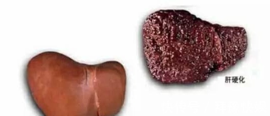 发痒|常吃3种调料的人,注意了!若身体2处发痒,可能是肝变硬的信号