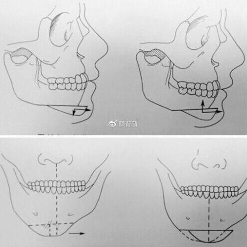 假体|颏成型术和假体垫下巴有啥区别？下巴短还后缩做哪个好？