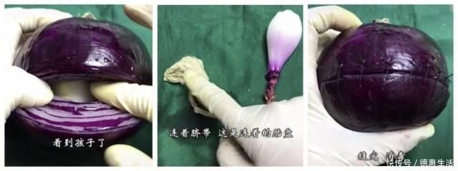 针头|剖腹产比顺产轻松？看完这些“手术工具”，别再说女人“矫情”