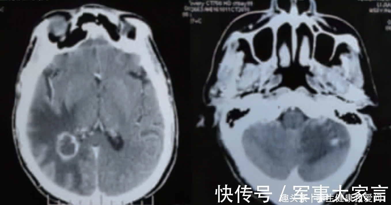 李明|打破肺癌晚期最多存活半年“魔咒”，晚期癌症带瘤生存4年病例