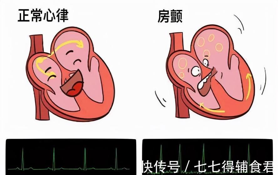 心房|预防房颤中风，丢掉阿司匹林！