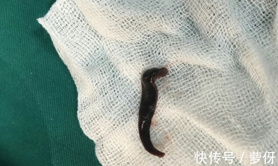 寄生虫|女子患肿瘤几乎丧命,医生从喉咙取出一条”大虫子”,网友:命大