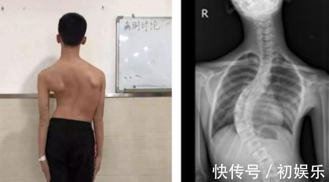 一肩|8岁男孩脊椎侧弯,只因家人常做这个动作,这个错误,90%的父母都在犯