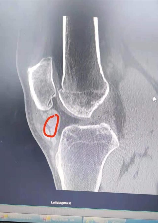 尿酸|尿酸高达856，关节里磨出石灰膏！医生：“这是我从医以来，见过的尿酸最高的患者”